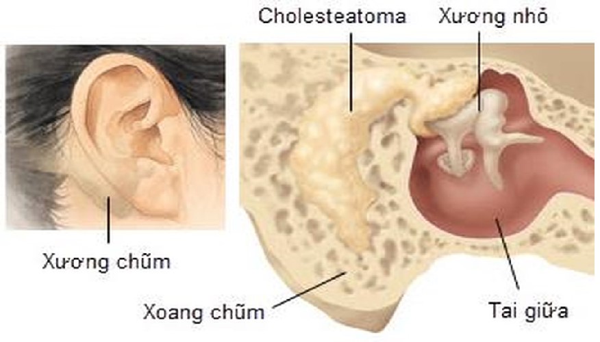 Viêm tai xương chũm - Hình ảnh minh họa